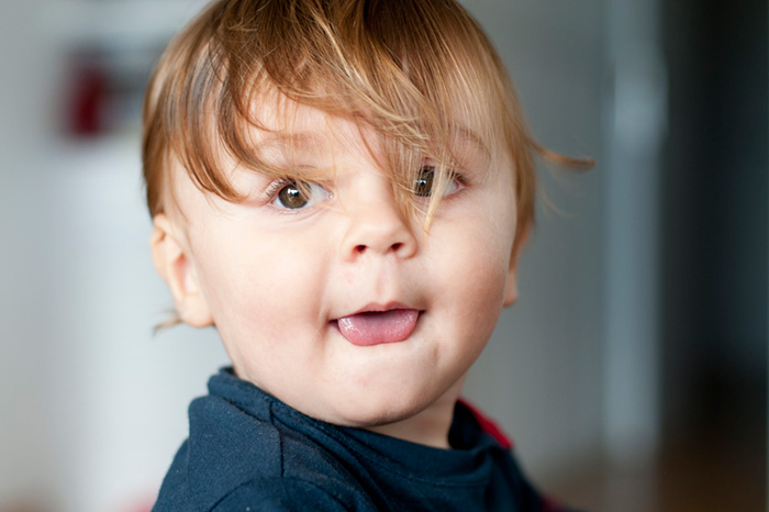 Ankyloglossia: tongue on short bridle () Ankyloglossia: short bridle tongue